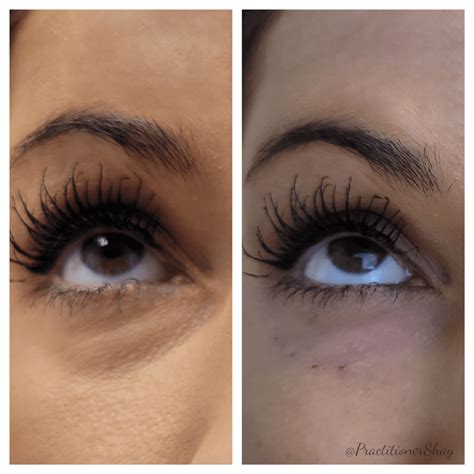 Under Eye Filler - Shay Novi Aesthetics & Wellness