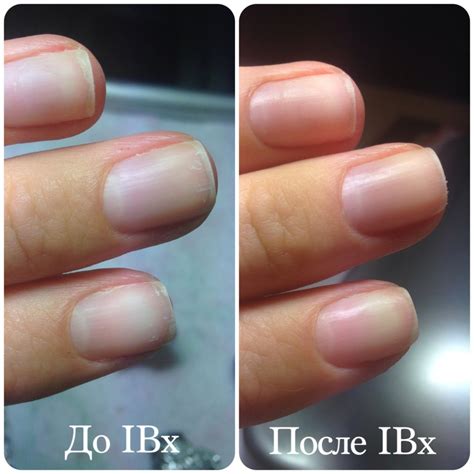 Как лечить онихолизис? Читайте на сайте интернет-магазине FRENCHnails