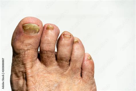 how to file toenails with fungus