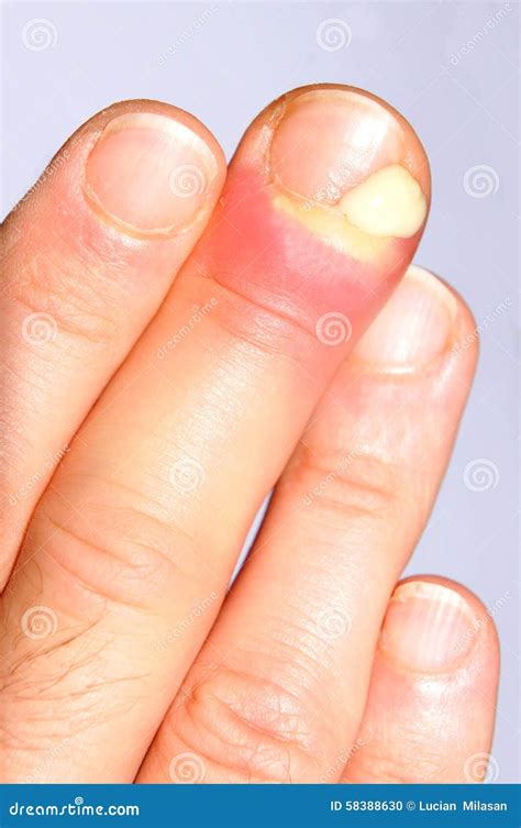 Puss stock photo. Image of drainage, inflammation, hand - 58388630