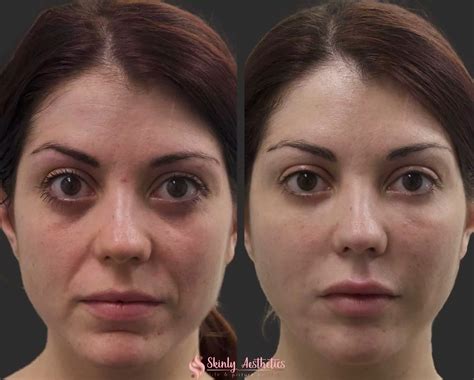 Under Eye Fillers - Before & After Results at Skinly