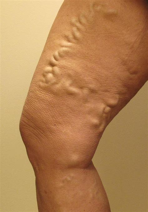 ¿Que son las varices? | Várices - Información y tratamiento