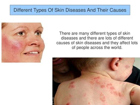 PPT - Different Types Of Skin Diseases And Their Causes PowerPoint ...