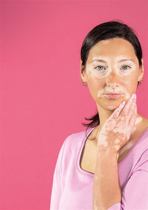 Welt-Vitiligo-Tag: Die Zeit ist reif - Für Betroffene mit Vitiligo ...