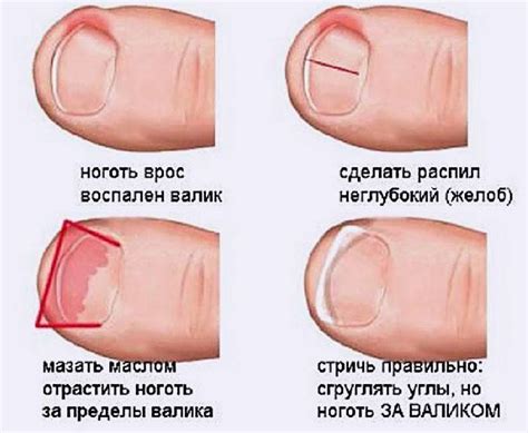 Вросший ноготь - причины и способы лечения