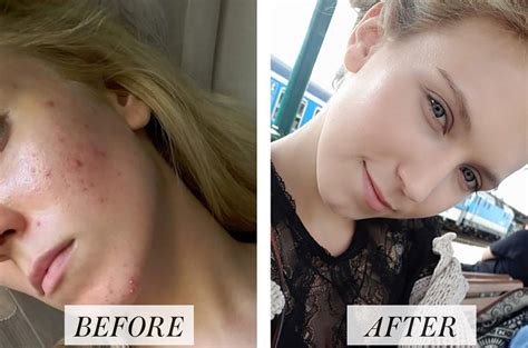 Woman's Before and After Accutane Photos Go Viral on Reddit | Allure