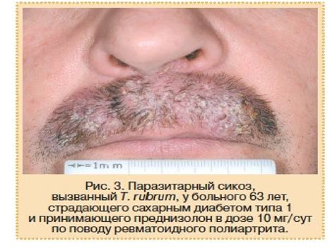 Мікози. Клінічна класифікація мікозів - презентация онлайн