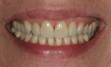 Cosmetic Veneers - Dr. Maria Chartz - Cosmetic Dentistry
