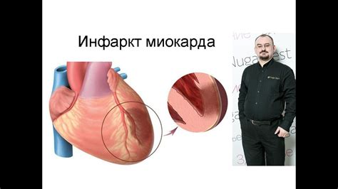 Инфаркт миокарда – проявление и лечение. - YouTube