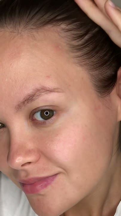 Противовоспалительные патчи Lanbena Acne Pimple Patch, 540 рублей - YouTube