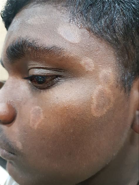 Polymorphous Light Eruption– An Indian Scenario - PMC
