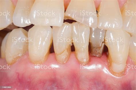 dental root caries stock photo  image  dental health