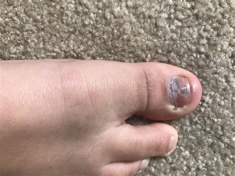 My foot after I got cleated. It bruised pretty badly on the nail and