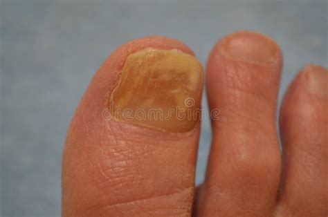 big toe toenail fungus   toes stock image image  portrait