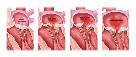 Mitral Valve Disease Background Diagnosis Treatment Options | My XXX