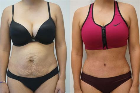 tummy tuck cost  turkey  frisky