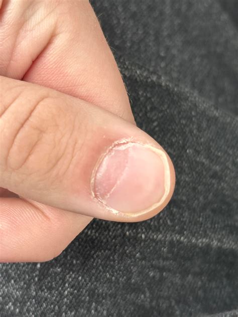 Fingernails are starting to grow in extremely damaged? : r/medical_advice