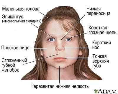 Алкогольный синдром плода: romix1c — LiveJournal