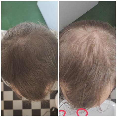 It is Telogen Effluvium or Androgenic Alopecia : r/tressless