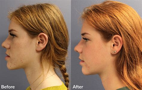 jaw surgery  overbite md burak sercan ercin