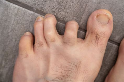Hammer toe surgery - gulugod