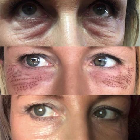 eyebag removal jet plasma  plasma     eye