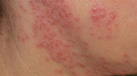 Eczema Blisters: Types, Causes, and Treatments