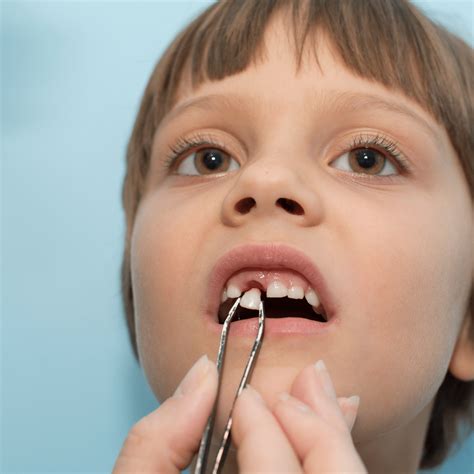 tooth removal understanding    extractions