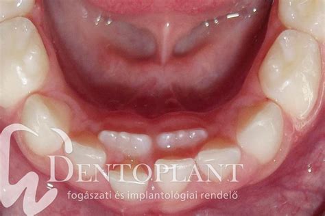 A fogváltás nehézségei – mi állhat a háttérben? | Dentoplant Fogászat ...