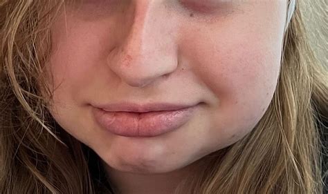 Swollen face after wisdom tooth removal - Page 3 | BabyCenter