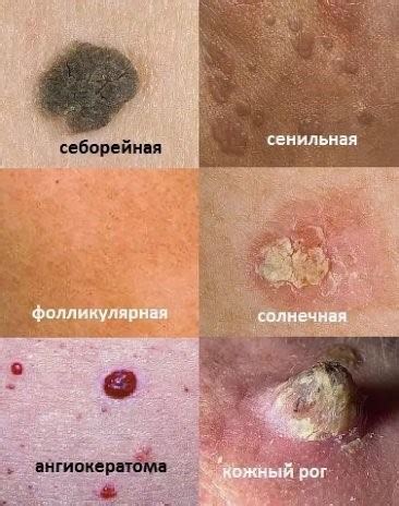Кератома что это такое? Как лечить, причины, симптомы и признаки ...