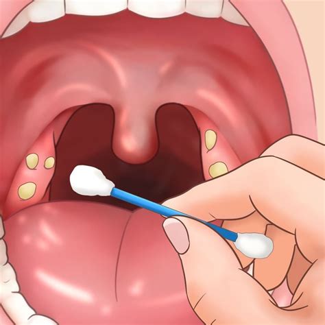 Como Eliminar Caseum Na Garganta - O que é Caseum? - Como tirar bolinhas brancas da garganta? | CliqueFarma