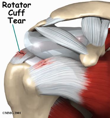 The Amazing Bodybuilding: Rotator Cuff Injury Symptoms