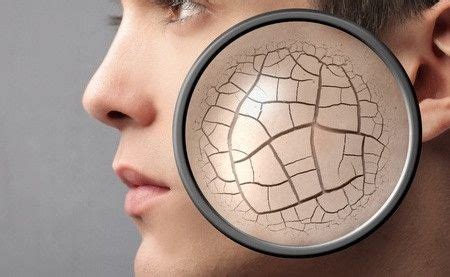 mengatasi kulit kering klikdokter