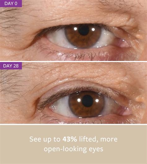 non-surgical EYELID LIFT – freezeframe-uk