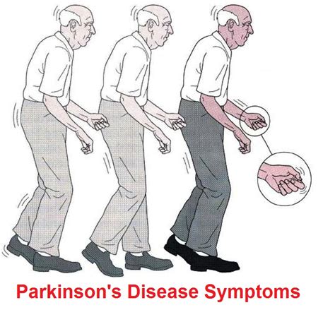 Parkinson's Disease: Signs And Symptoms, Diagnosis, Treatment And ...