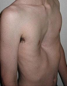 marfan syndrome chest