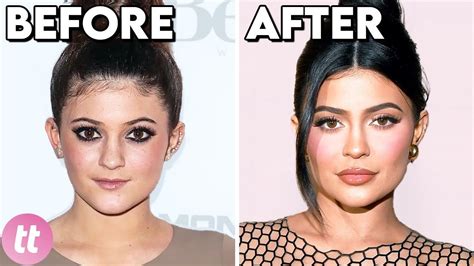 Celebrities Before And After Plastic Surgery
