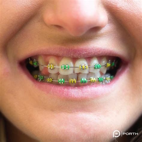 braces colors   pick   color   braces