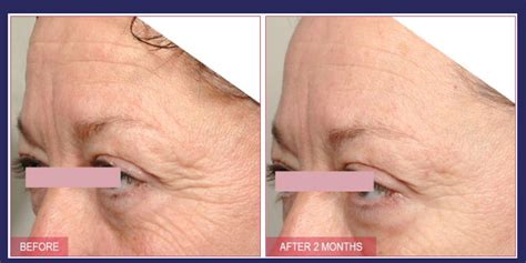 Peptídeos Matrixyl Antes E Depois
