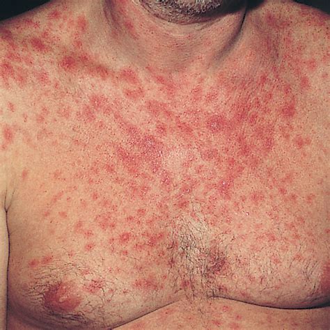 Does Hiv Cause Dark Spots On Lips | Lipstutorial.org