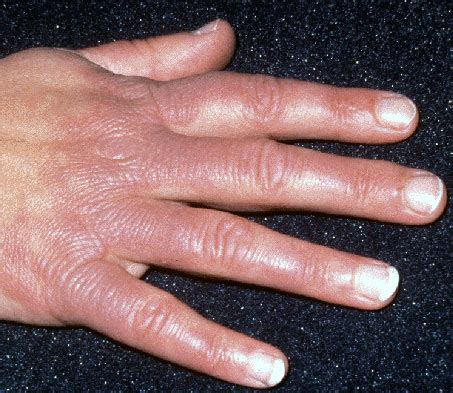 Erythema elevatum diutinum