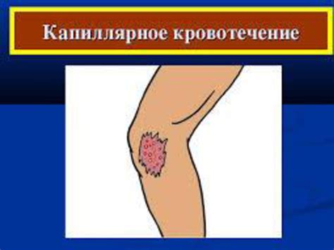 Презентація "Види кровотеч"