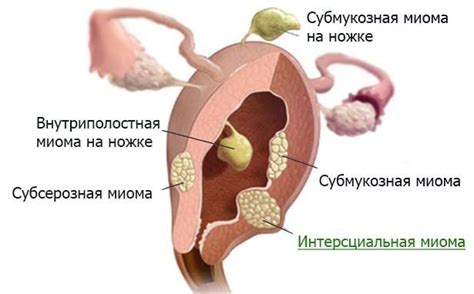 Миома матки - Институт здоровья