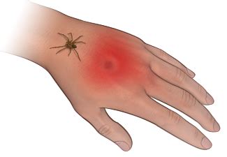 Poisonous Spider Bites