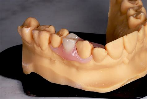 Flexible Partial Dentures - Simply Teeth