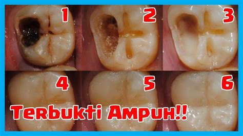 Obat Untuk Gigi Berlubang - Resep Obatku