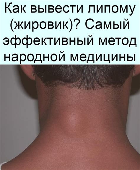 Как вывести липому (жировик)? Самый эффективный метод народной медицины ...