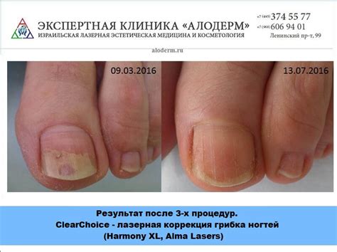 Грибок Кожи Фото После — New-Freepik.Ru