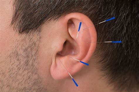 Ear Acupuncture for Weight Loss - Alternative Medicine Now